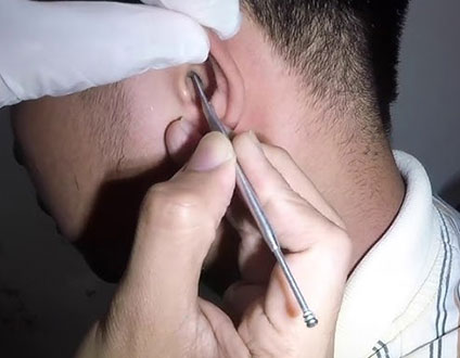 Best Ear Wax & Foreign Body Removal Treatment in Vashi
